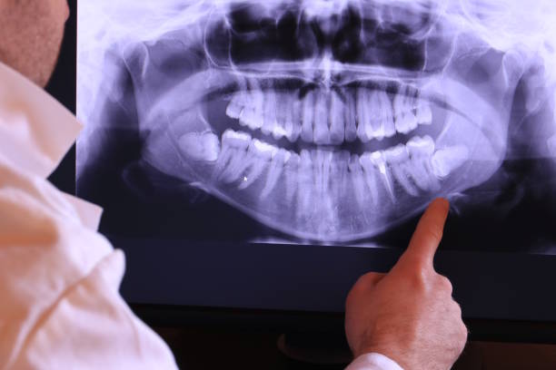 Best Emergency Root Canal Treatment in North Charleston, SC