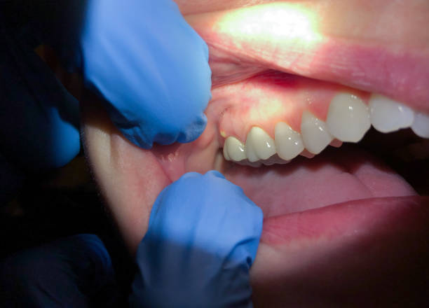 Best Emergency Gum Treatment in North Charleston, SC