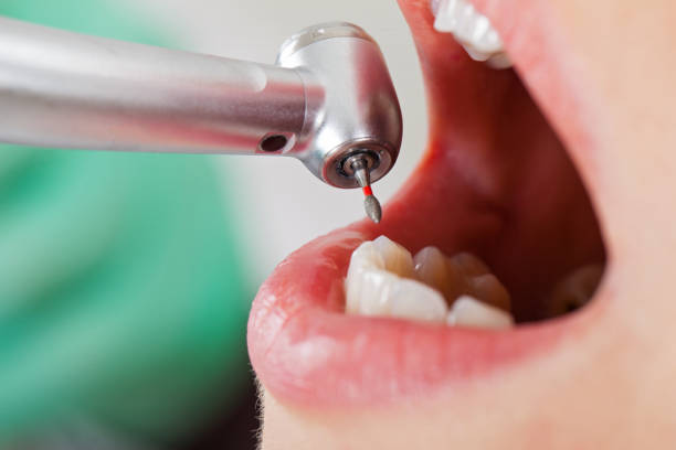 Best Emergency Treatment for Dental Infections or Abscesses in North Charleston, SC